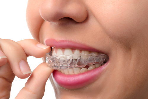 Clear aligner treatment including Invisalign and CandidPro