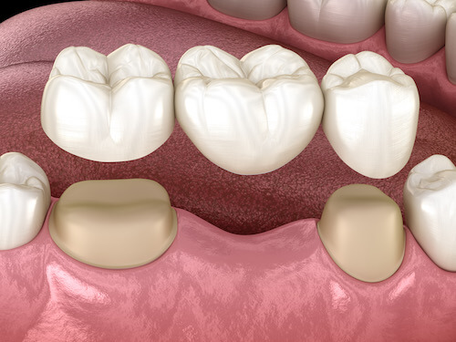 Crowns and bridges dental restoration