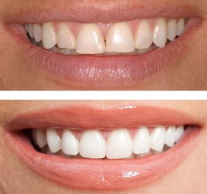 Dental bonding treatment