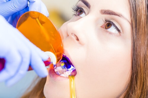 Dental fillings for cavities