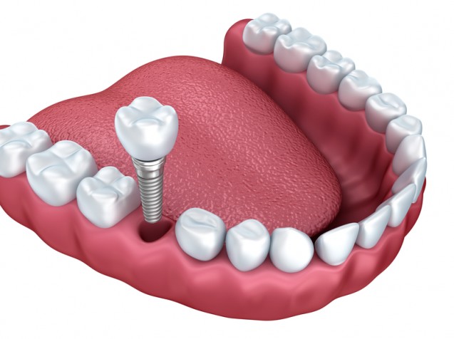 Dental implant procedure