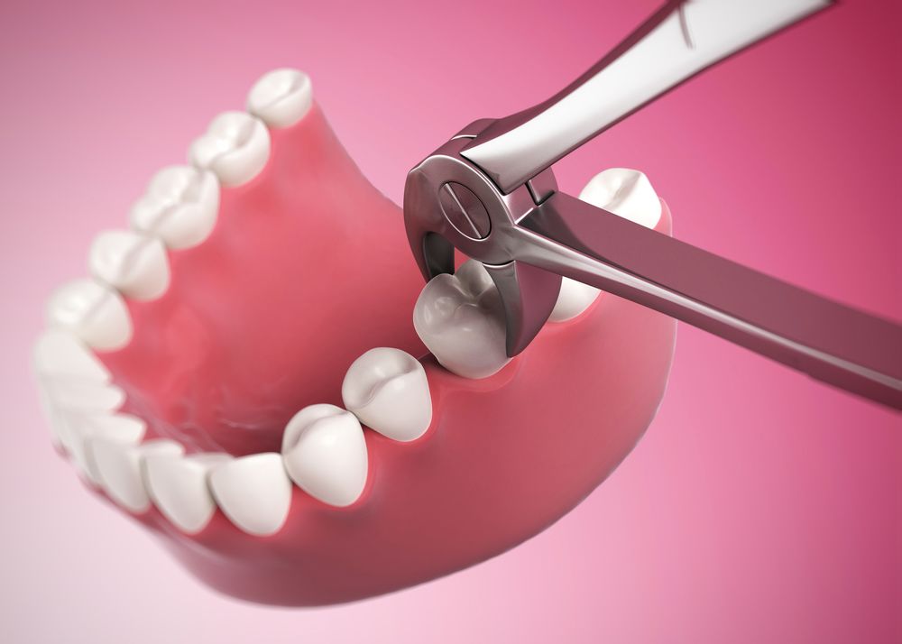 Tooth extraction procedure
